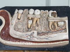 A 19th Century Plaster Didactic Model of Malformed Teeth