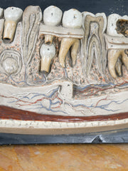 A 19th Century Plaster Didactic Model of Malformed Teeth